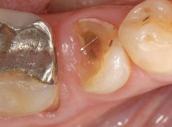 Restorative Treatments For Lesions  With Subgingival Margins