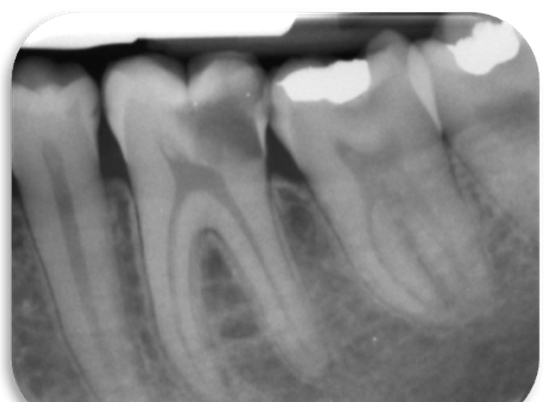 Quick Poll Results Endodontics