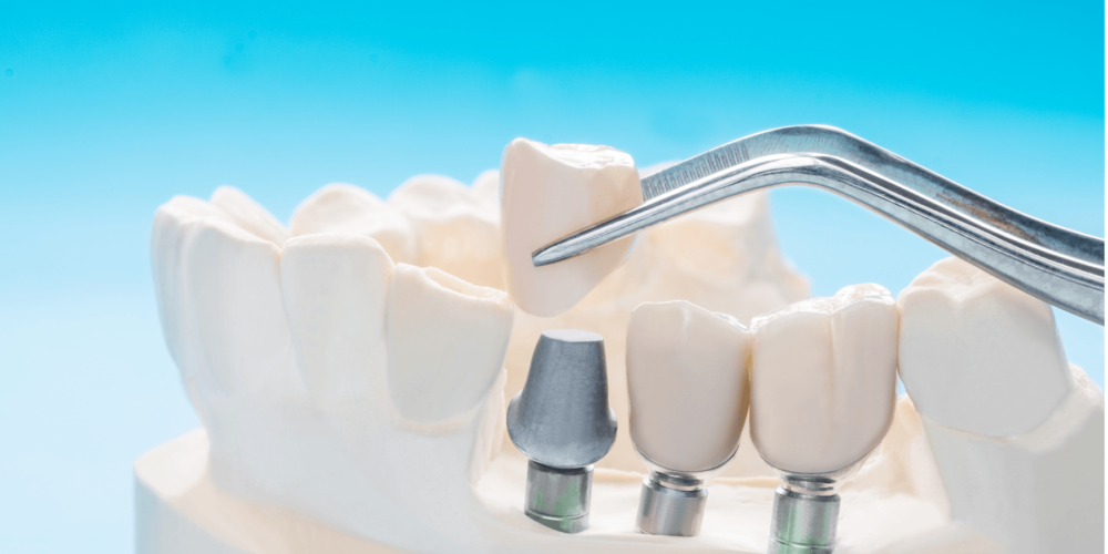 The Dental Implant Restoration Registry Study Is Recruiting Dentists Who Restore Implants