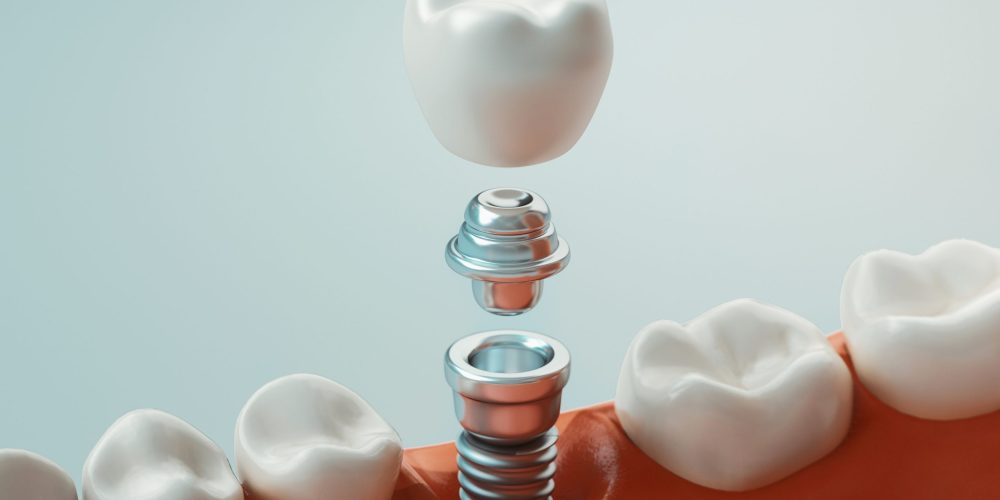 Webinar: Dental Implant Restoration Registry: Why Dentists Should Participate