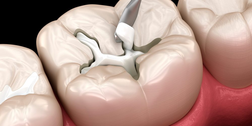 How Long Do Posterior Composite Fillings Typically Last?